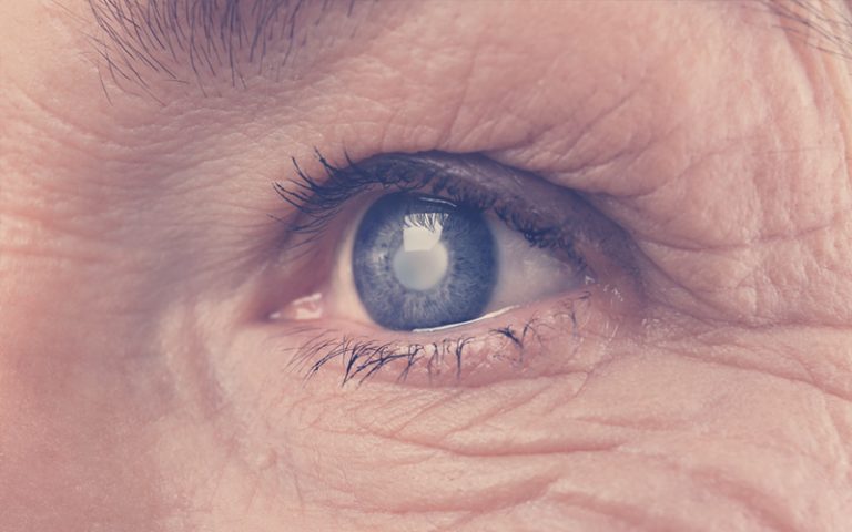 Ojo de una persona mayor con glaucoma, mostrando una opacidad en la córnea y una pupila dilatada