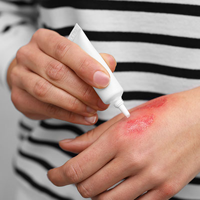 mujer aplicando crema