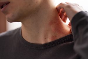 enfermedad de Hansen